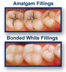 White Dental Fillings Oakland CA